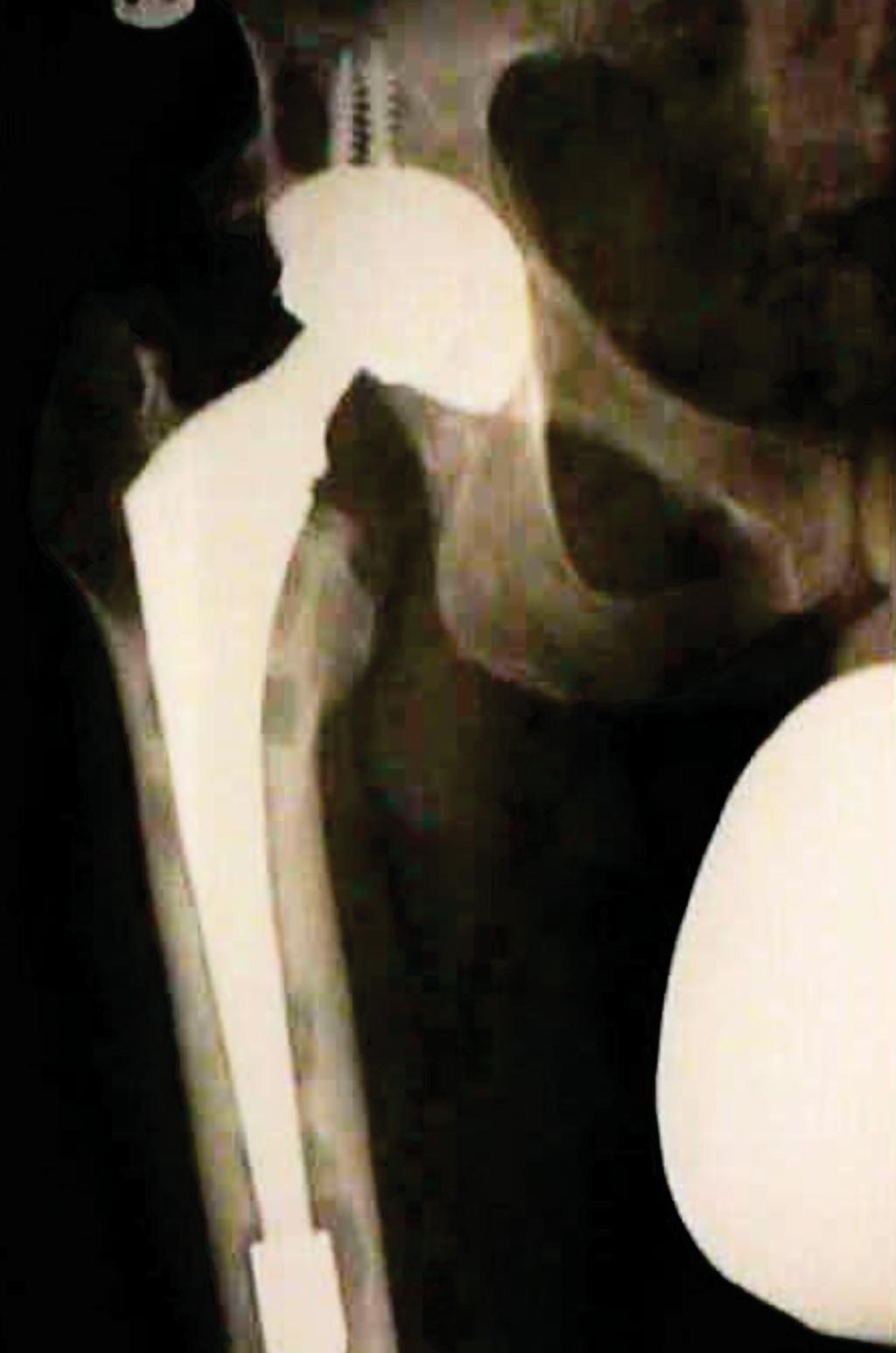 Image: A radiograph of 50-year-old patient with a well-placed acetabular cup against the tear drop and well placed femoral stem; after seven years, the patient has developed extensive osteolysis (Photo courtesy of Duke University Medical Center).