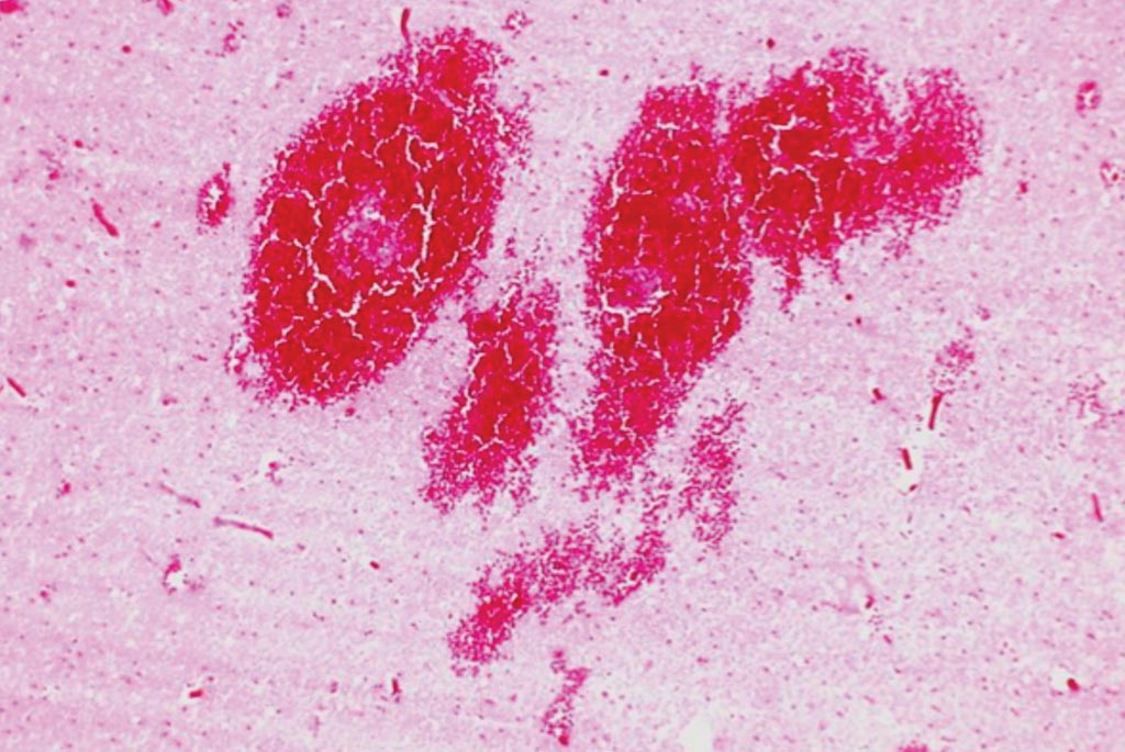 Image: Histology of the brain, showing infarct and hemorrhage due to ruptured saccular aneurysm and thrombosis of right middle cerebral artery (Photo courtesy of Peter Anderson).
