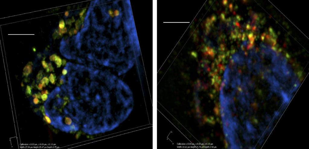 Image: Three-dimensional super-resolution microscopy shows that breast cancer cells (left) contain many large multivesicular bodies (green and red) that are full of exosomes ready to be released from the cell. In the absence of Munc13-4 (right), multivesicular bodies are much smaller and incapable of releasing their contents (Photo courtesy of Messenger et al., 2018).
