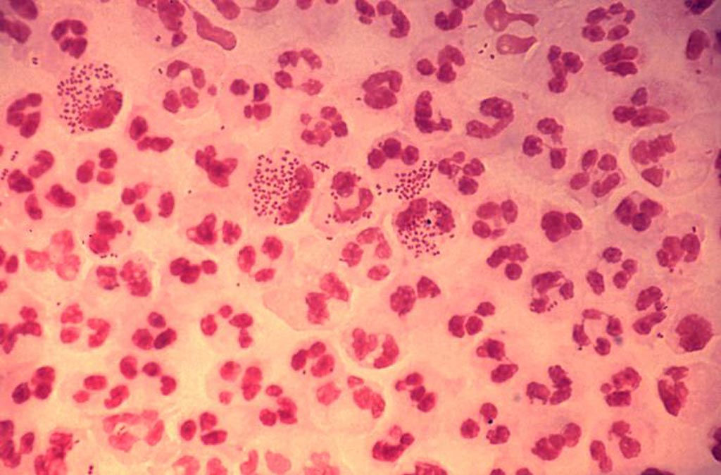 Image: This photomicrograph reveals the histopathology in an acute case of gonococcal urethritis using Gram-stain technique. This slide demonstrates the non-random distribution of gonococci among polymorphonuclear neutrophils. Note that there are both intracellular and extracellular bacteria in the field of view (Photo courtesy of the CDC).