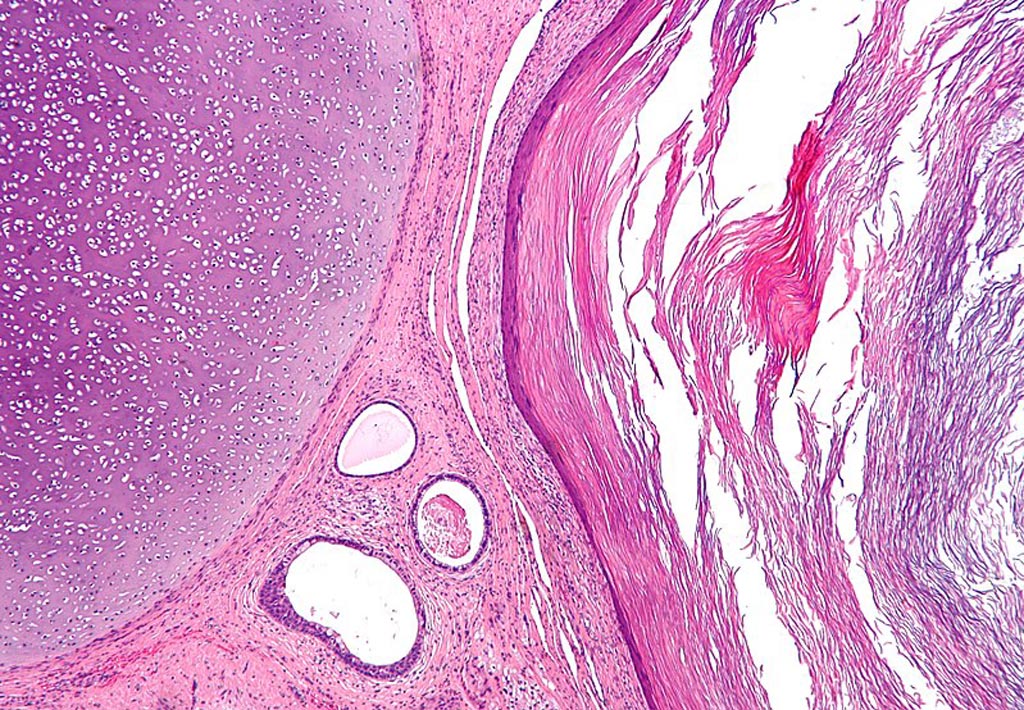 Image: A micrograph of a teratoma showing tissue from all three germ layers: mesoderm (immature cartilage - left-upper), endoderm (gastrointestinal glands - center-bottom) and ectoderm (epidermis - right) (Photo courtesy of Wikimedia Commons).