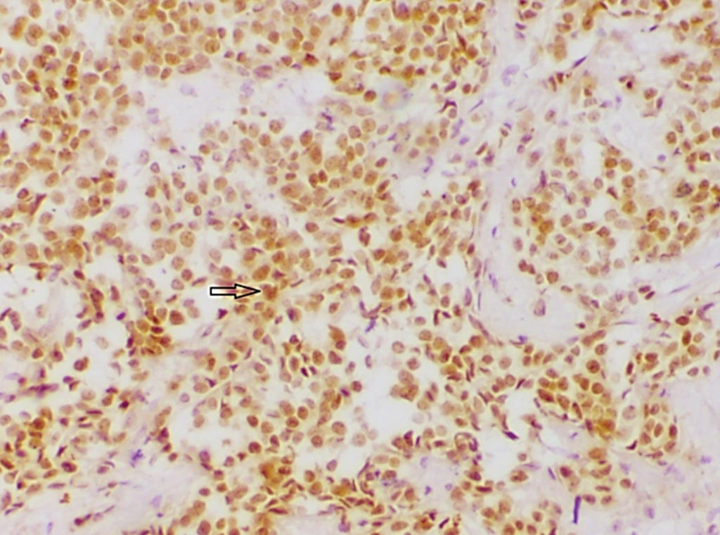 Image: An immunohistochemistry staining for expression of the estrogen receptor positivity (ER+) showing strong nuclear reactivity (Photo courtesy of the Indian National Institute of Pathology).