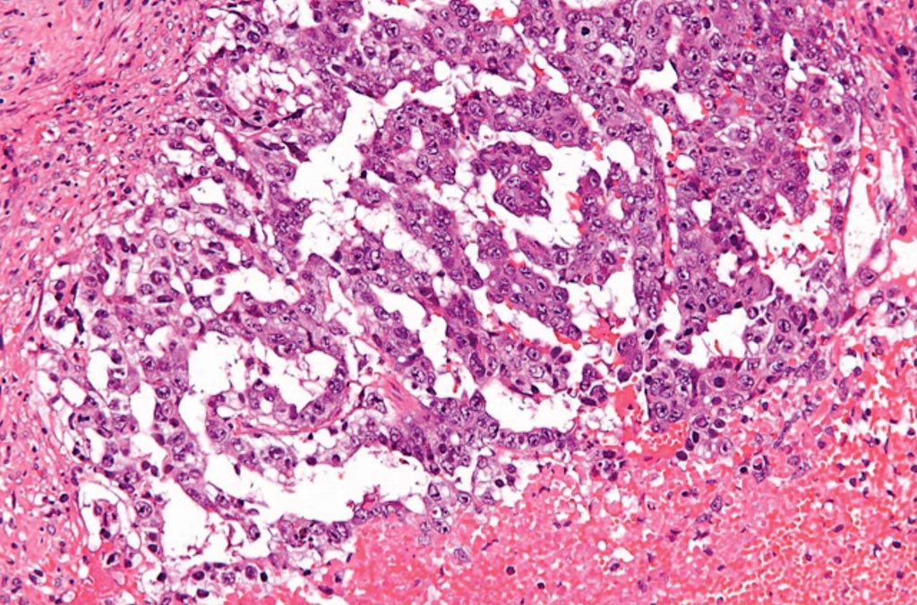 Image: A histopathology of mixed germ cell tumor of the testes demonstrating the high-grade cytology, typical for embryonal carcinoma (Photo courtesy of Nephron).