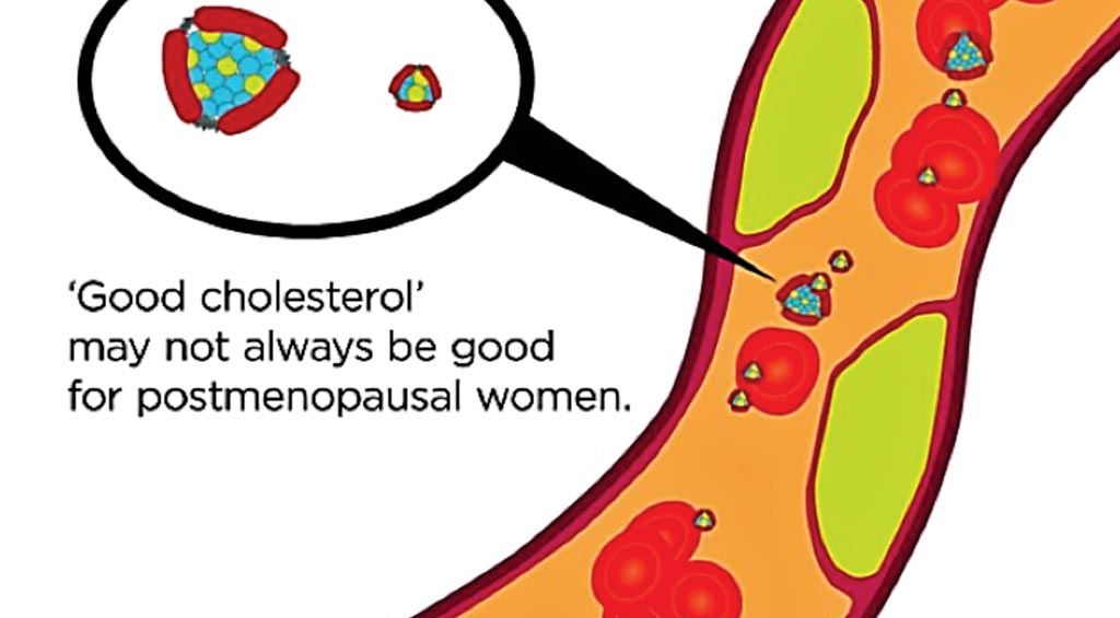 Image: Postmenopausal factors may have an impact on the heart-protective qualities of high-density lipoproteins (HDL), also known as ‘good cholesterol (Photo courtesy of University of Pittsburgh Medical Center).