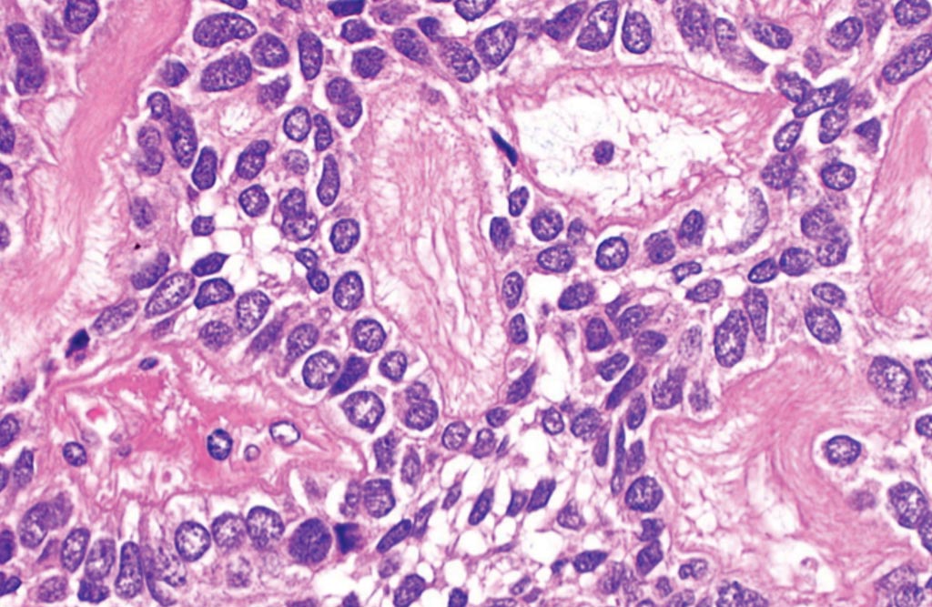 Image: A histopathology of adenoid cystic/basal cell carcinoma of the prostate gland (Photo courtesy of Nephron).