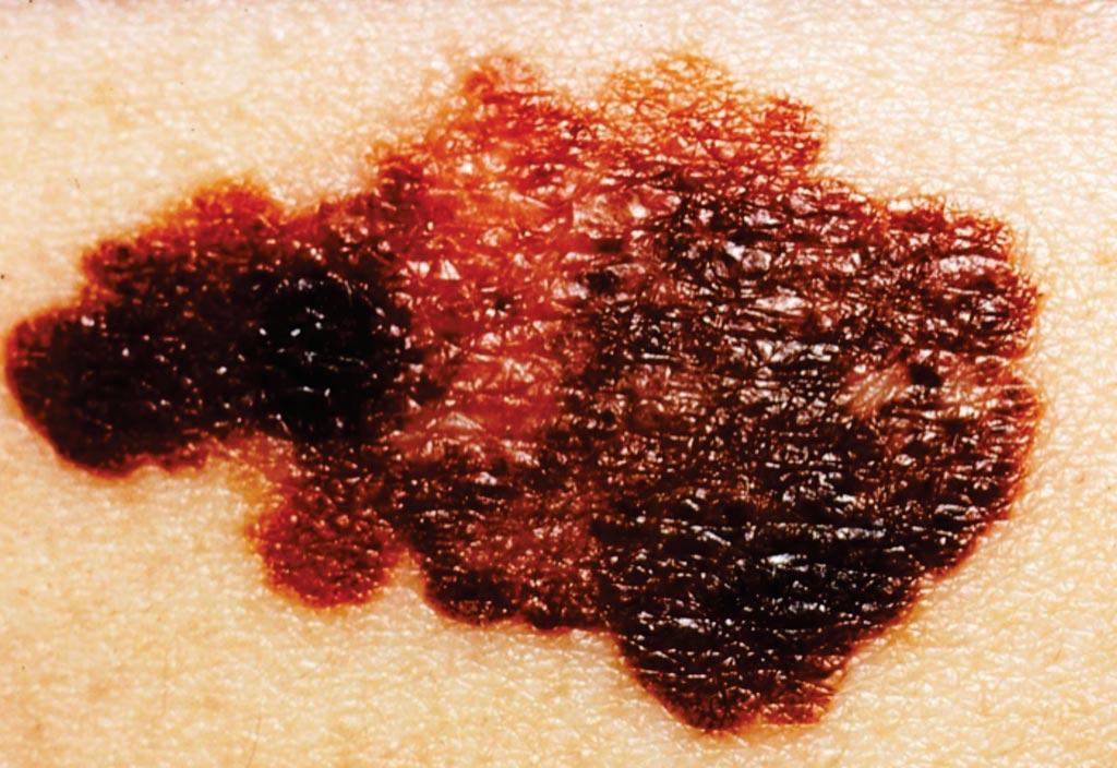 图片：皮肤的恶性黑色素瘤（图片蒙国家癌症研究所惠赐）。