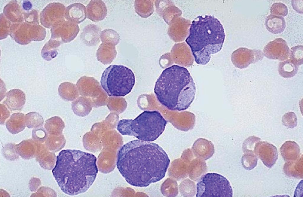 图片：一名急性骨髓性白血病患者的血液涂片显示极大的不成熟成髓细胞，它有许多核仁。这些成髓细胞的鲜明特征是红色线状的“Auer小体”，由晶体化颗粒组成（图片蒙犹他大学医学院惠赐）。