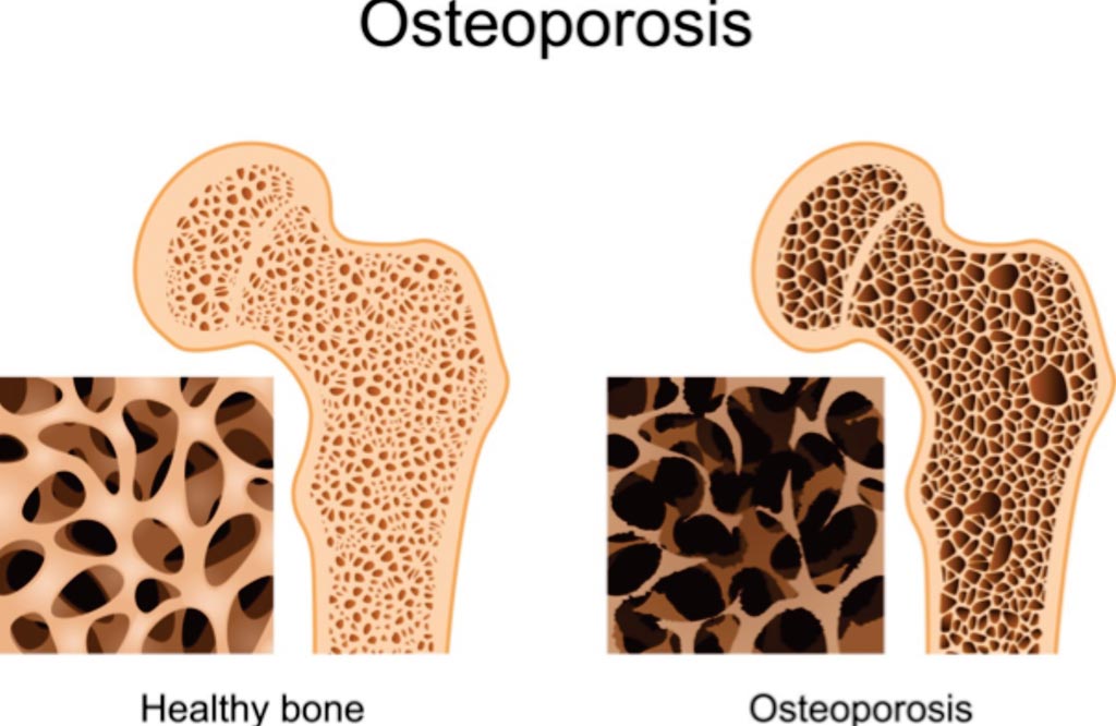 Image: A comparison of healthy bone and osteoporosis (Photo courtesy of PharmacyPedia).