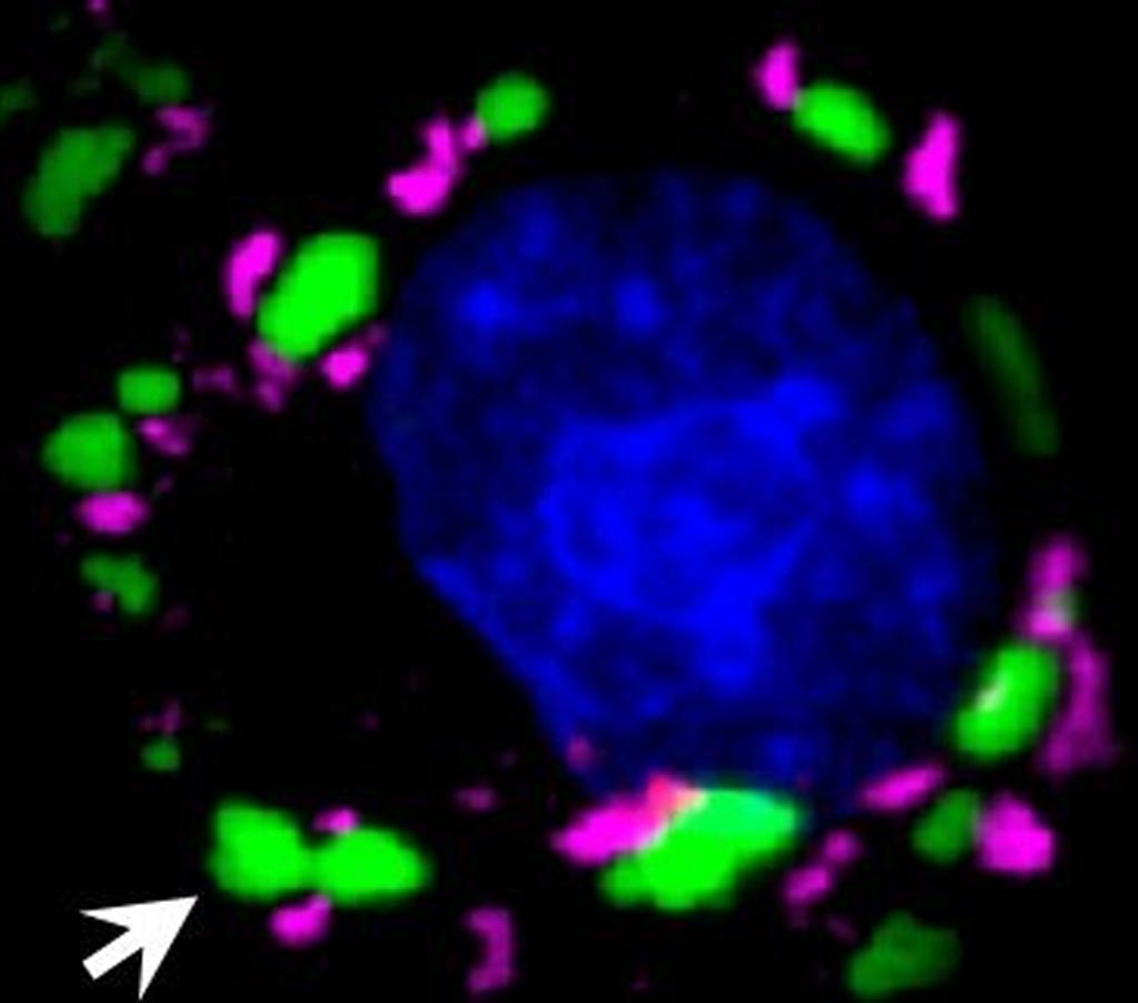 Image: In cells under duress, stress granules (in magenta) form outside of the nucleus (in blue). TDP-43 protein in green (arrow) that cannot bind to polyADP ribose (PAR) builds up in large clumps distinct from stress granules (Photo courtesy of Leeanne McGurk, University of Pennsylvania).