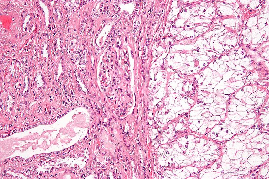 Image: A micrograph of the most common type of renal cell carcinoma (clear cell) on right of the image; non-tumor kidney is on the left of the image (Photo courtesy of Wikimedia Commons).