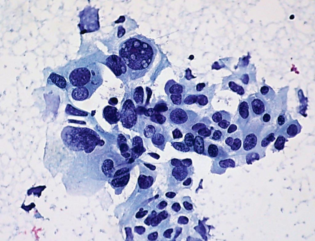 Image: A histopathology of non-small cell lung cancer from a fine needle aspirate showing marked variation in nuclear size and shape, irregularly distributed nuclear chromatin, and large, prominent nucleoli (Photo courtesy of Ed Uthman, MD).