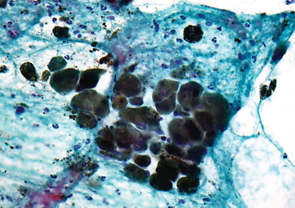 图片：巴氏染色的细胞样本中恶性黑色素瘤被染色后的显微图像（图片蒙Nephron惠赐）。