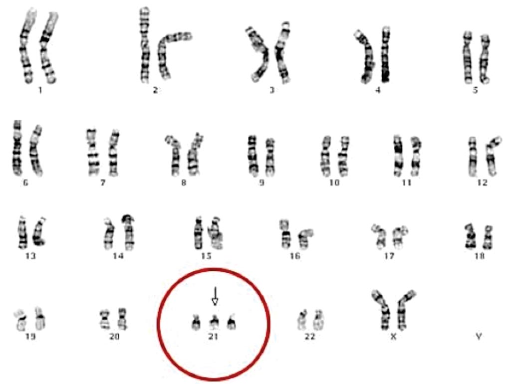 Image: Karyotyping of Trisomy 21 in a female: There is a full set of 23 homologous pairs of autosomes, but an extra chromosome 21 (Photo courtesy of Dr. Daniel Closa).