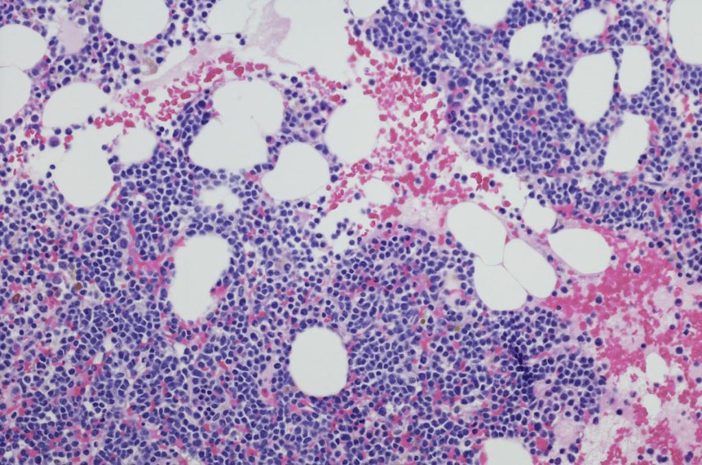 Image: Multiple myeloma, a cancer of the blood plasma (Photo courtesy of Medical News Today).