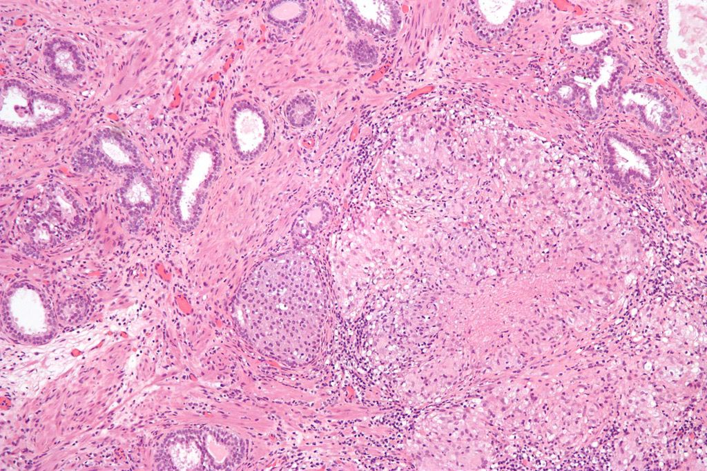 Image: A micrograph showing granulomatous inflammation of bladder neck tissue due to Bacillus Calmette-Guérin (BCG) used to treat bladder cancer (Photo courtesy of Wikimedia Commons).