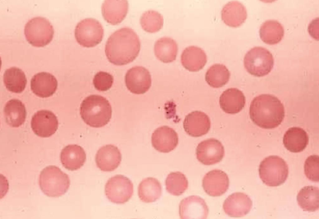 Мазок крови показывает гетерогенность размера периферических эритроцитов, известную как анизоцитоз (фото любезно предоставлено доктором медицины Джей Парк (Jay Park)).