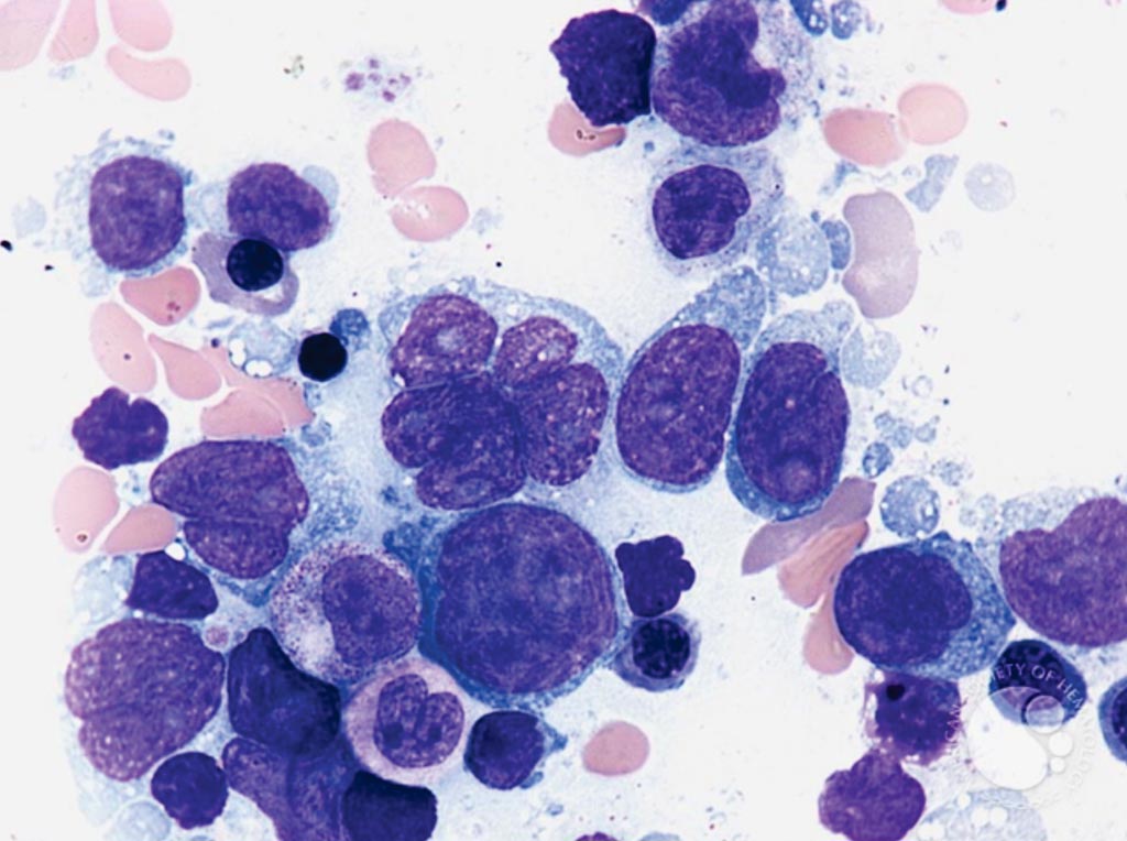 Image: Bone marrow aspirate from a patient with diffuse large B cell lymphoma (Photo courtesy of Peter Maslak).