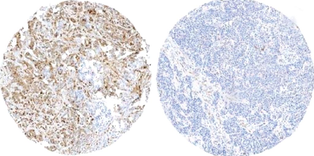 Image: Breast tissue from a relapsed patient with active phosphorylation markers (left; brown color), compared to breast tissue from a patient without relapse and who does not have these active markers (right) (Photo courtesy of Centro Nacional de Investigaciones Oncológicas).