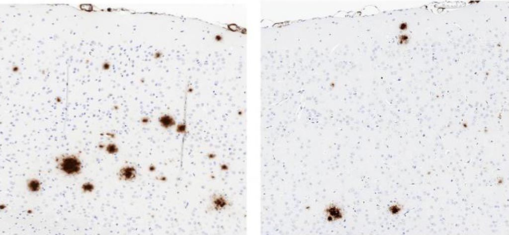 Image: Compared to a control (left), a soluble version of TLR5 (right) reduced the formation of amyloid plaques (brown) in the brains of mice that produced large amounts of human beta-amyloid (Photo courtesy of Chakrabarty et al., 2018).