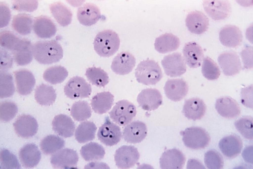 Image: A photomicrograph of a Giemsa-stained, thin film blood smear that reveals the presence of numerous of ring-form, Plasmodium falciparum trophozoites, with some infected red blood cells (RBCs) harboring multiple organisms (Photo courtesy of CDC / Steven Glenn).