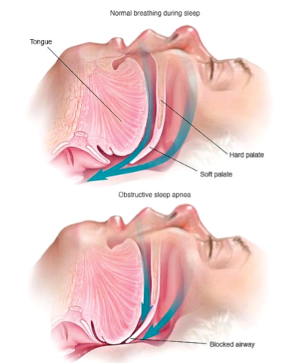 Иллюстрация обструктивного апноэ во сне по сравнению с нормальным дыханием во время сна (фото предоставлено клиникой Майо).