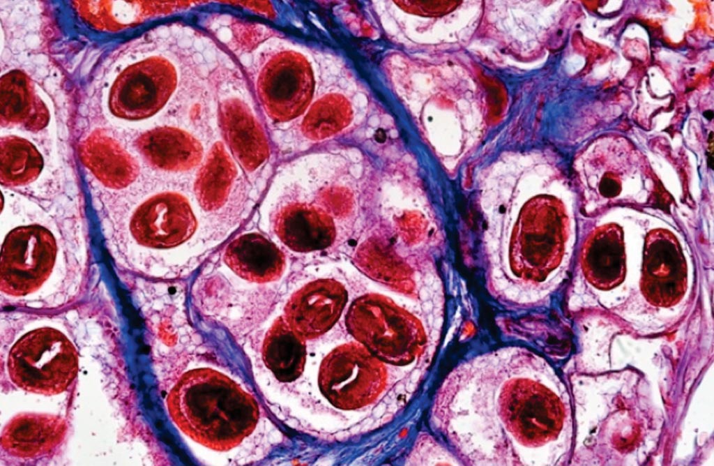 Image: A photomicrograph of histological preparation of a liver with numerous cysts of the cestode Echinococcus granulosus, the cause of cystic echinococcosis or hydatid disease (Photo courtesy of D. Kucharski and K. Kucharska).