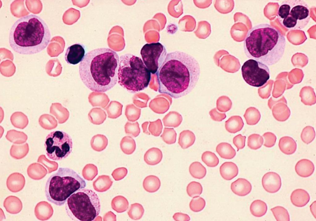 Image: A blood film from a patient with acute myeloid leukemia (Photo courtesy of the University of Toronto).