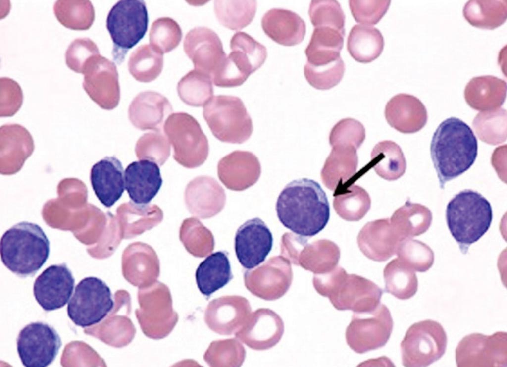 Мазок крови пациента с хроническим лимфоцитарным лейкозом (ХЛЛ); большой лимфоцит (стрелка) имеет ядро с надрезом и демонстрирует переменное появление некоторых лимфоцитов в ХЛЛ (фото любезно предоставлено Петером Маслаком/Peter Maslak).