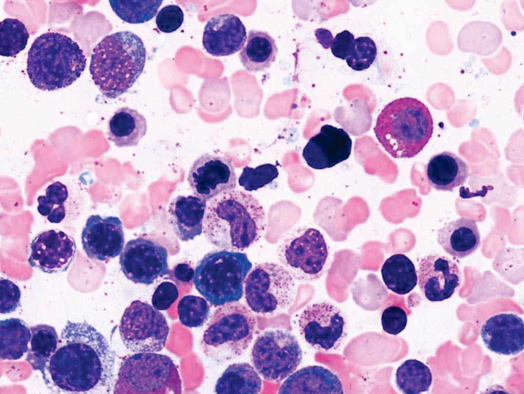 Image: Bone marrow aspirate smear from a patient with myelodysplastic syndromes, unclassifiable (MDS-U) (pancytopenia and -7 cytogenetic abnormality). Occasional late mitotic figures in erythroid elements are present, but no significant erythroid or myeloid dysplasia exists (Photo courtesy of Dr. Robert P. Hasserjian, MD).