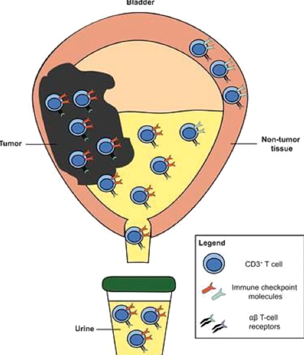 Image: A diagram of urine-derived lymphocytes as a non-invasive measure of the bladder tumor immune microenvironment (Photo courtesy of University College London).