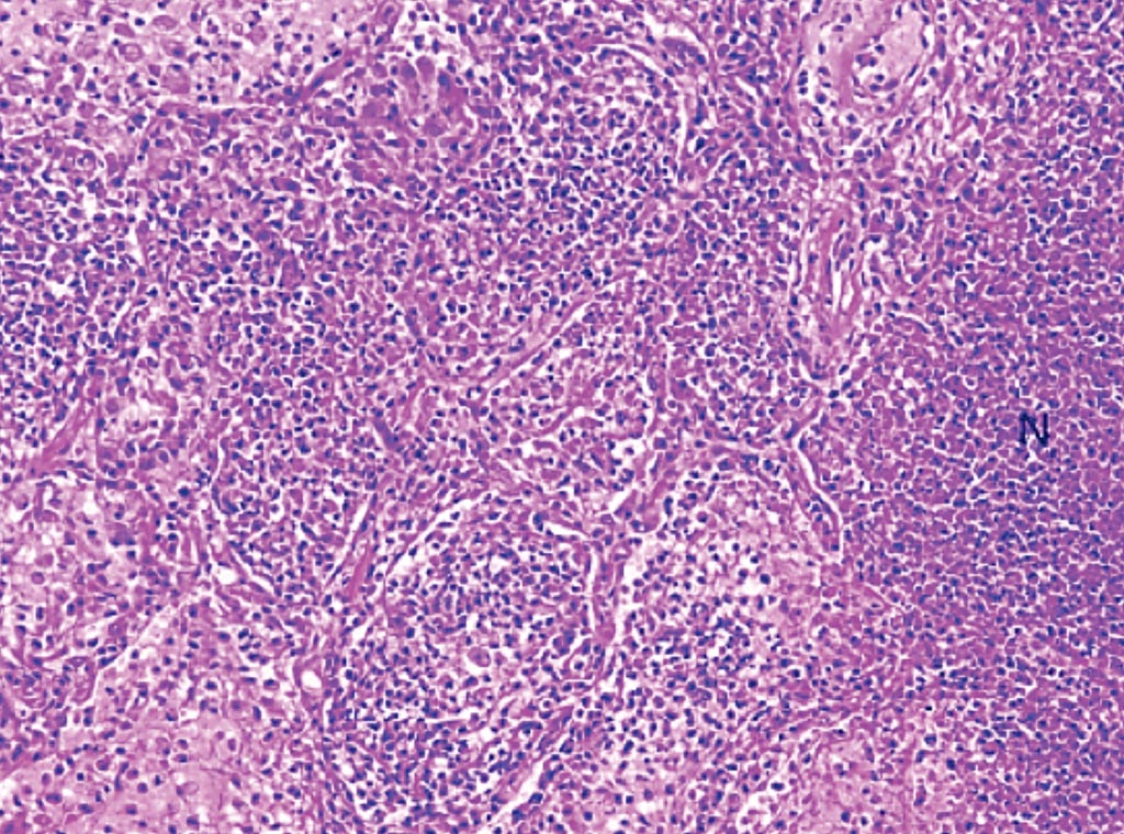 Image: A histopathology of interstitial lung disease showing acute injury with necrosis. Necrosis (N) is a harbinger of infection in an acutely ill patient. Infection always leads the differential diagnosis in this situation, even if special stains are negative (Photo courtesy of Professor K.O. Leslie).