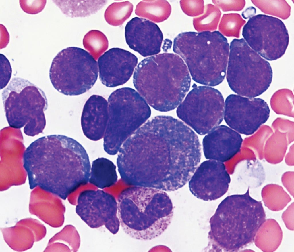 Image: Bone marrow aspirate of a patient with acute lymphoblastic leukemia revealing increased blasts which are small to medium in size with high nuclear-to-cytoplasmic ratios, round to irregular nuclei, smooth chromatin, and scant basophilic agranular cytoplasm. Some background maturing myeloid cells are also present in this case (Photo courtesy of Dr. Karen M. Chisholm).