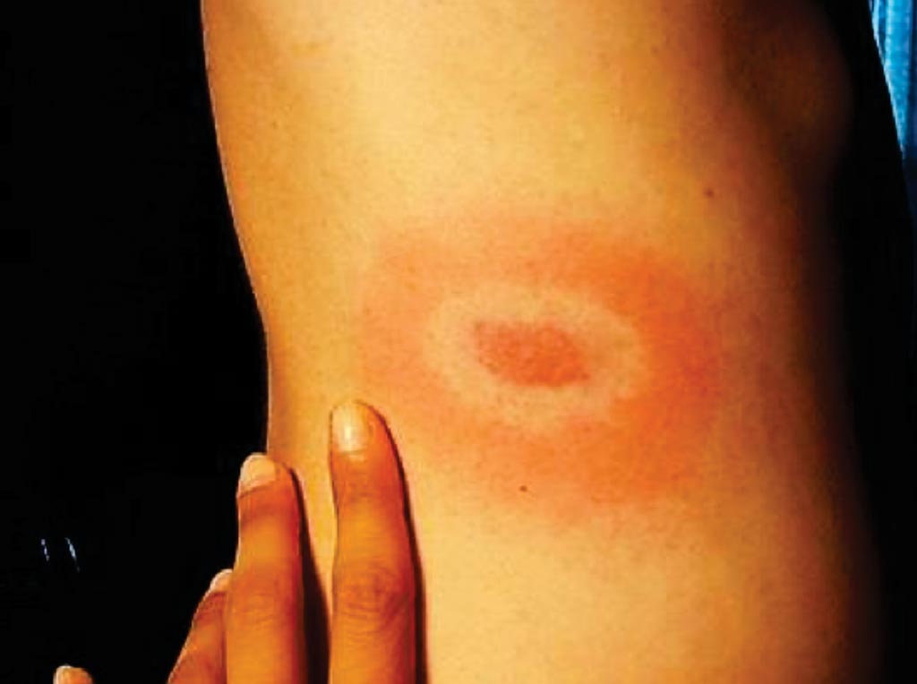 Image: Erythematous rash in the pattern of a “bull’s-eye” from a patient with Lyme disease (Photo courtesy of Hannah Garrison).