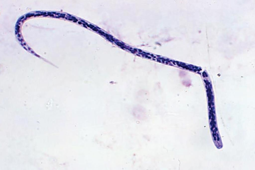 Микрофотография личинки Onchocerca volvulus microfilaria, причины онхоцеркоза  - речной слепоты (фото любезно предоставлено доктором Ли Муром (Dr. Lee Moore)/Центр по контролю и профилактике заболеваний).