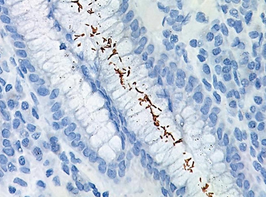 Иммуноокрашивание инфекции Helicobacter pylori в тонком кишечнике. Небольшую спирально изогнутую бактерию можно увидеть с использованием масляного объектива ×100 под микроскопом (фото любезно предоставлено BioCare Medical).