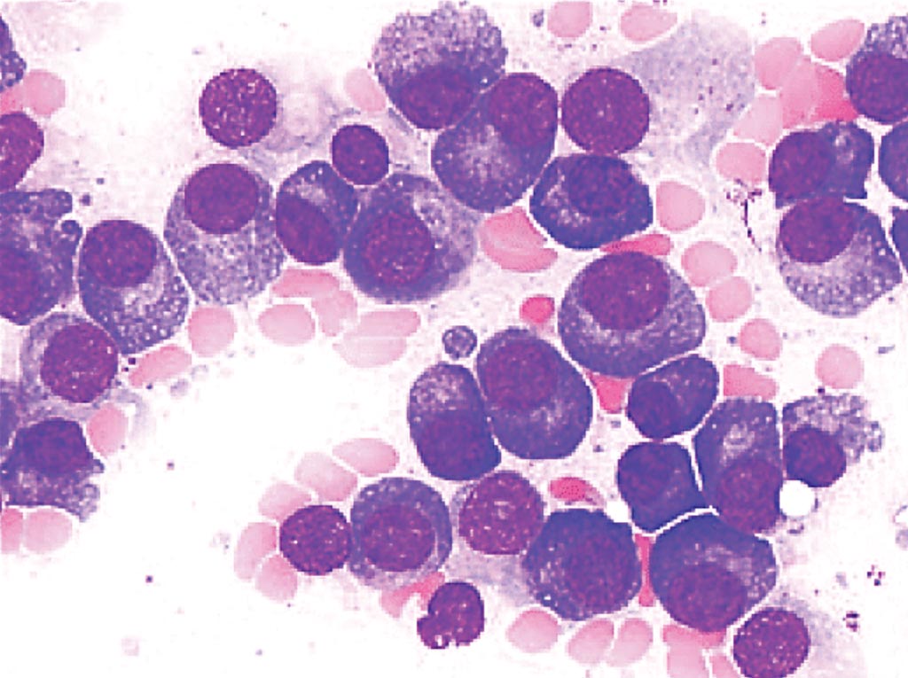 Image: Bone marrow aspirate from a patient with multiple myeloma showing plasmacytosis (Photo courtesy of Feinberg School of Medicine).