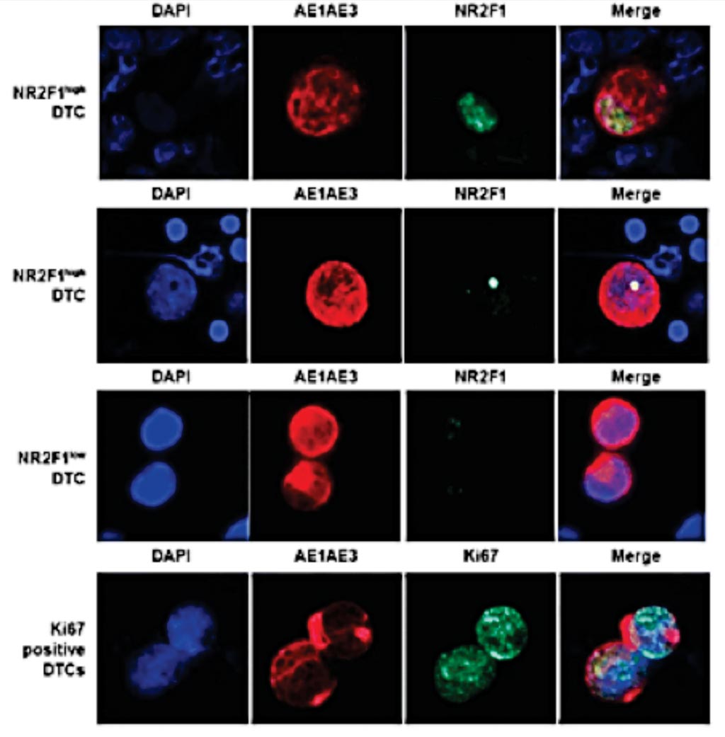 Диссеминированные опухолевые клетки (ДОК), выделенные с помощью двойного иммунофлюоресцентного окрашивания (AE1AE3/NR2F1 и AE1AE3/ Ki67), и корреляция между экспрессией Ki67 и NR2F1 (фото предоставлено Школой медицины Икана Медицинского центра Маунт-Синай).