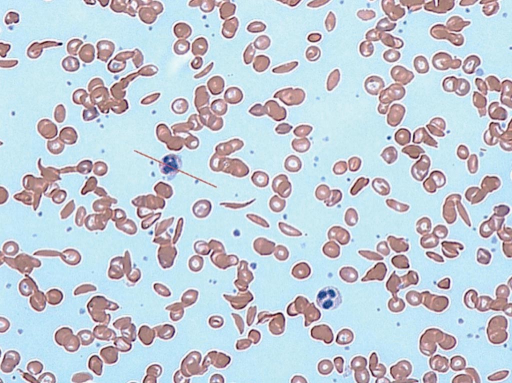 Image: A photomicrograph of sickle cells in human blood: both normal red blood cells and sickle-shaped cells are present (Photo courtesy of Dr. Graham Beards).
