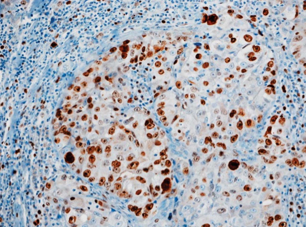 Иммуноокрашивание клеток рака молочной железы, рисунок распределения индекса Ki67 в клетках рака молочной железы (фото предоставлено Сегедским университетом).