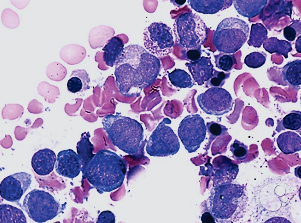 Image: A bone marrow smear of a patient with Acute Myeloid Leukemia; dysplastic changes are noted in both the granulocytic and erythroid lineages (Photo courtesy of Peter Maslak).