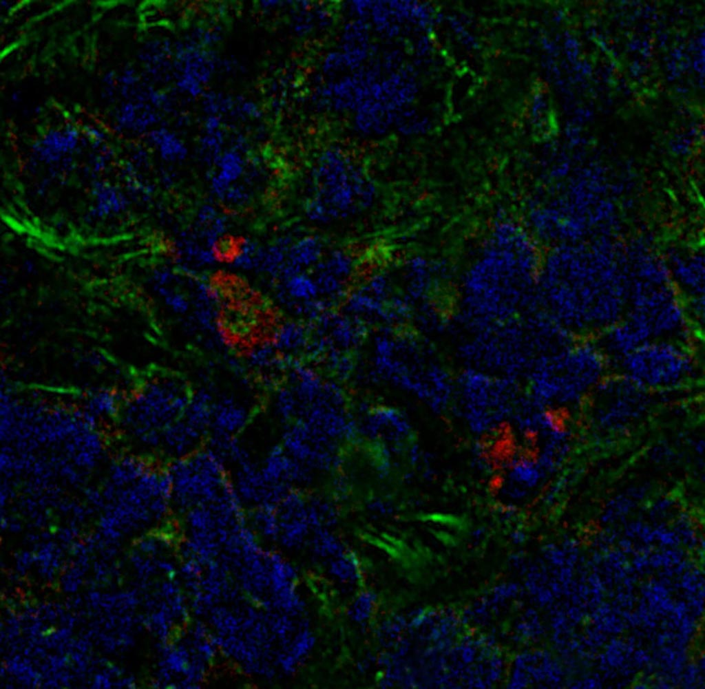Image: A mouse breast tumor that contains bone marrow-derived fibroblasts (red) as well as other cancer-associated fibroblasts (green) (Photo courtesy of Raz et al., 2018).