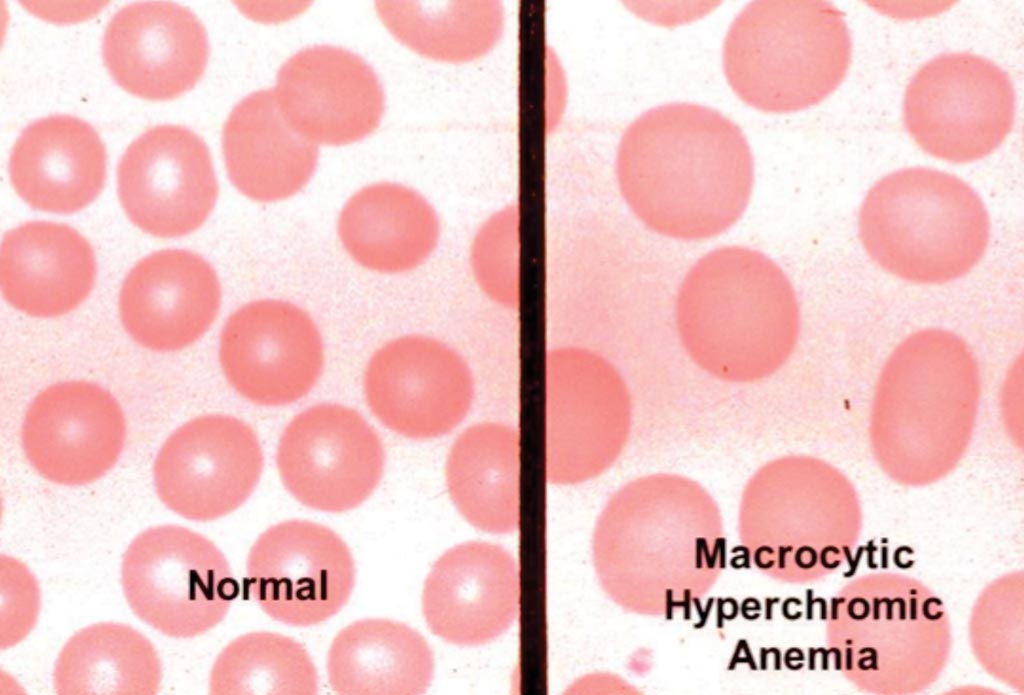 Image: Blood smears from normal and macrocytic anemia patients (Photo courtesy of Myrtle Porter).