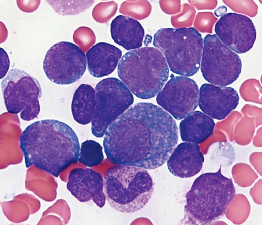 Image: Bone marrow aspirate smear from a patient with acute lymphoblastic leukemia reveals increased blasts which are small to medium in size with high nuclear-to-cytoplasmic ratios, round to irregular nuclei, smooth chromatin, and scant basophilic agranular cytoplasm (Photo courtesy of Karen M. Chisholm MD, PhD).