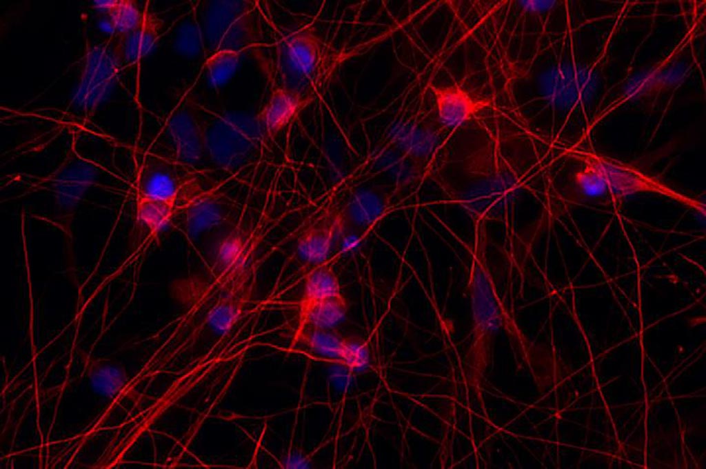 Image: The photomicrograph shows neurons (red) with a mutation in the MAPT gene - a gene that makes the protein tau. People with this mutation develop frontotemporal dementia. Researchers found that cells carrying the MAPT mutation developed abnormalities in genes that control communication between the brain cells (Photo courtesy of Sidhartha Mahali, Washington University School of Medicine).
