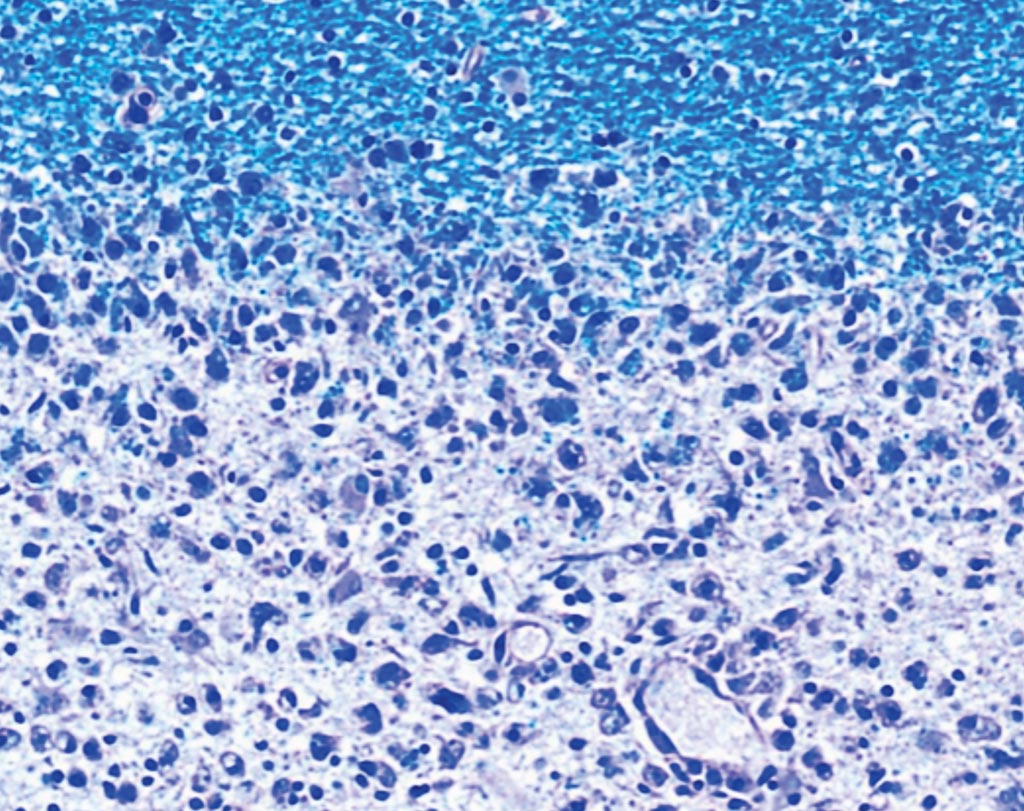 Уменьшение миелиновых оболочек: на поврежденных участках мозга пациентов (внизу изображения) с рассеянным склерозом не хватает миелина (вверху, синего цвета). Фото любезно предоставлено доктором медицины Имке Метц /Imke Metz/, Университет Геттингена.
