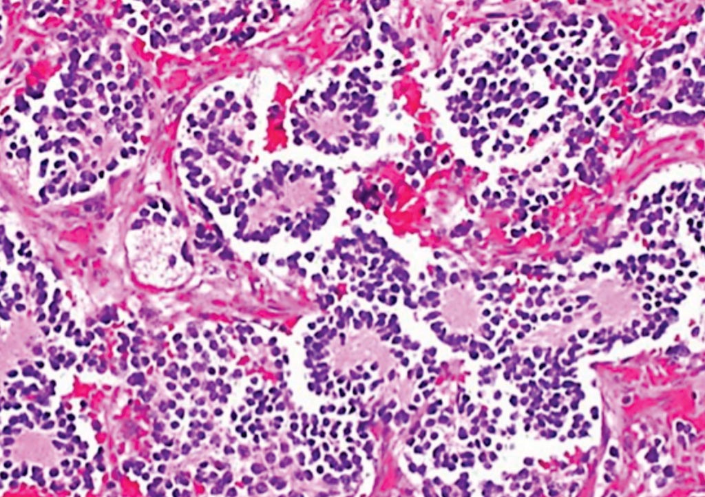 Image: Histopathology of a typical neuroblastoma with rosette formation (Photo courtesy of Dr. Mark Applebaum, MD).