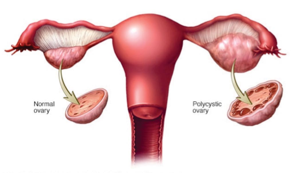 Image: A diagram showing normal and polycystic ovary syndrome, in the latter the ovaries may develop numerous small collections of fluid (follicles) and fail to regularly release eggs (Photo courtesy of Mayo Clinic).
