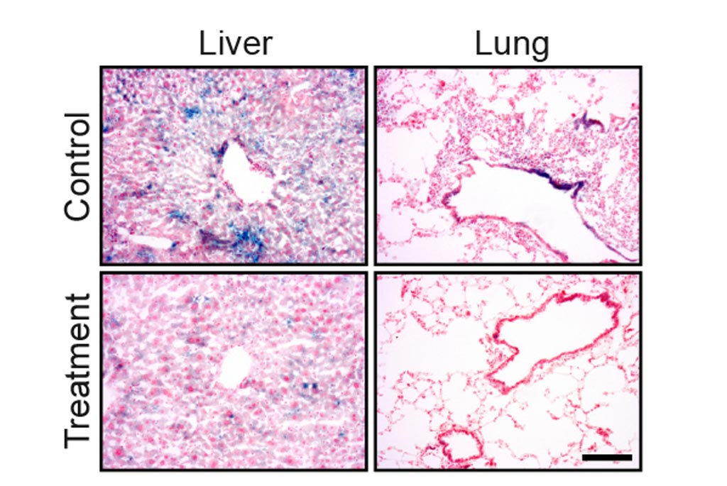 Image: Drug treatment eliminates senescent cells from tissues of old mice. The blue staining shows senescent cells in lung and liver tissue. The amount of the staining is significantly reduced following the drug treatment (Photo courtesy of The Weizmann Institute of Science).