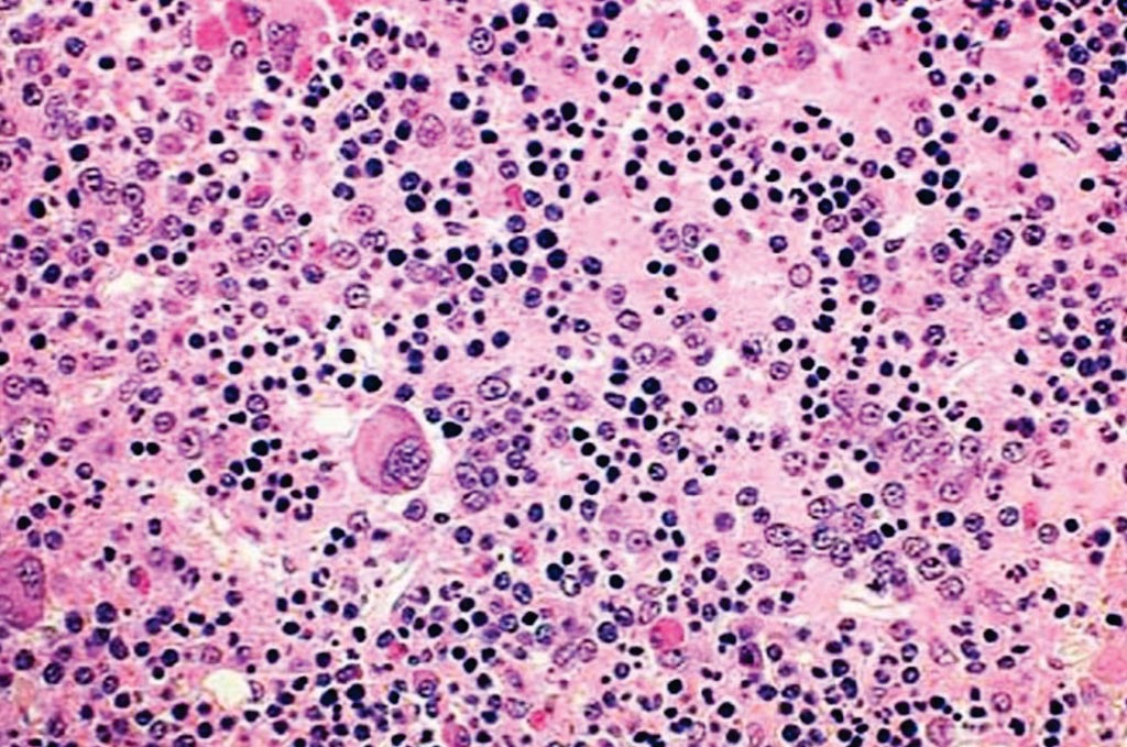 Image: Bone marrow biopsy from a patient with polycythemia vera showing a hypercellular marrow as a result of an increase of myeloid, erythroid and megakaryocytic elements (Photo courtesy of Karl Theil MD).