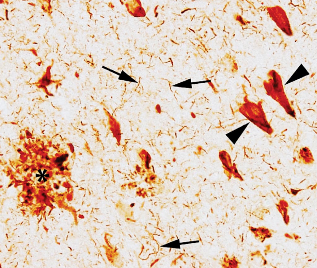 Срез из гиппокампа пациента с болезнью Альцгеймера, окрашенный антителом к тау-белку (TNT1). Следует обратить внимание на классическую триаду патологий тау при БА, 1) нейрофибриллярные клубки (указатель стрелки), 2) нейропильные нити (стрелки) и 3) нейритическая бляшка (звездочка). Фото любезно предоставлено Мичиганским государственным университетом.